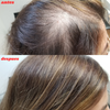Set Capilatis Ortiga Concentrado Shampoo - 3 en 1